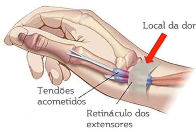 Tendinite de De Quervain: a dor no polegar e no punho que atrapalha o dia a dia